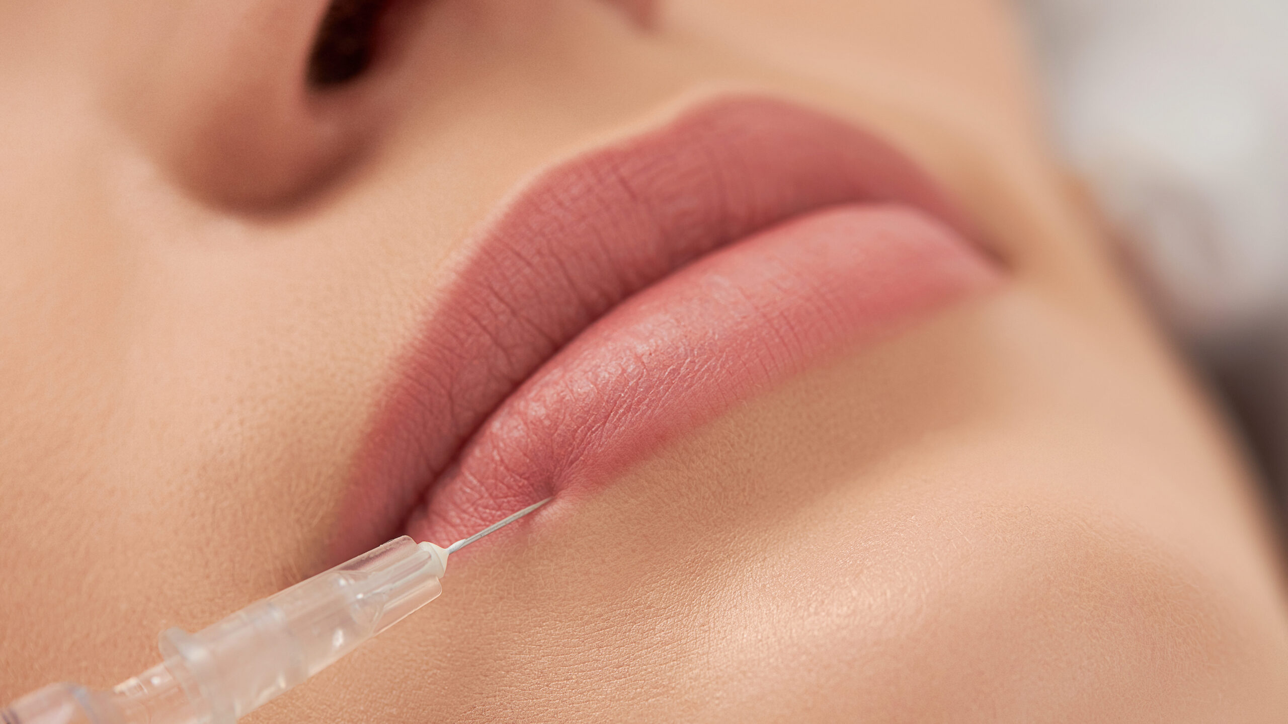Nahaufnahme weiblicher Lippen mit Hyaluronsäureinjektion